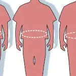 Cosa è la Chirurgia Bariatrica